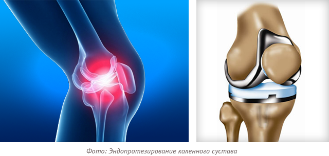 фото эндопротезирование коленного сустава